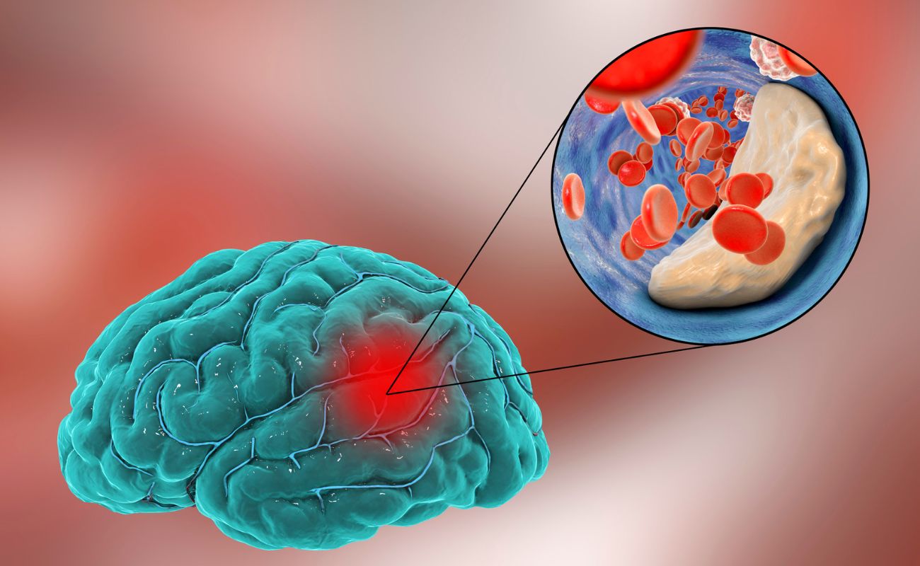 Trombosi farmacologica in paziente con ictus ischemico