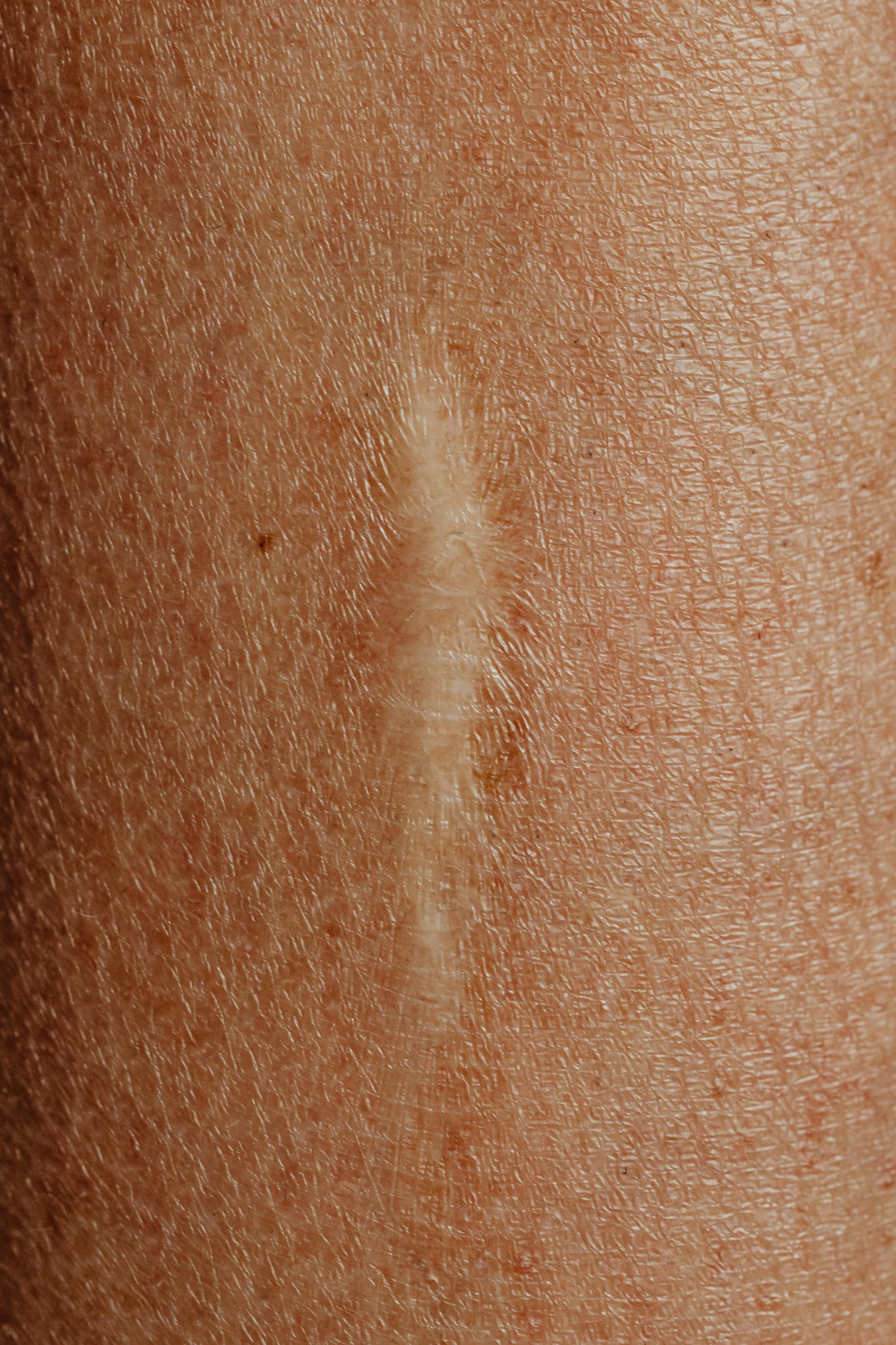 Linfoma Cutaneo: La Rara Neoplasia della Pelle da Conoscere e Affrontare