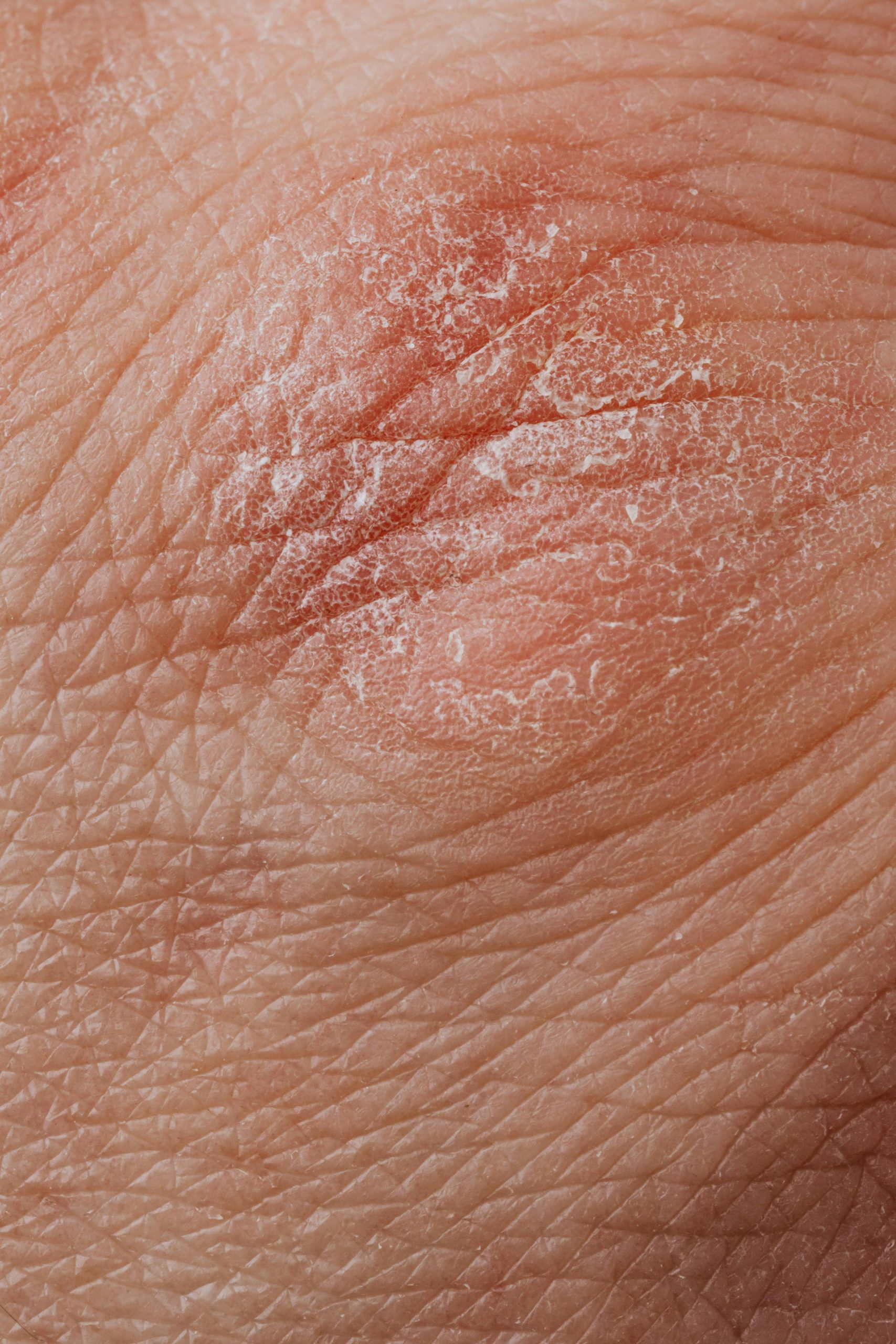 Pelle sensibile: conosci la dermatite atopica e impara a riconoscerla