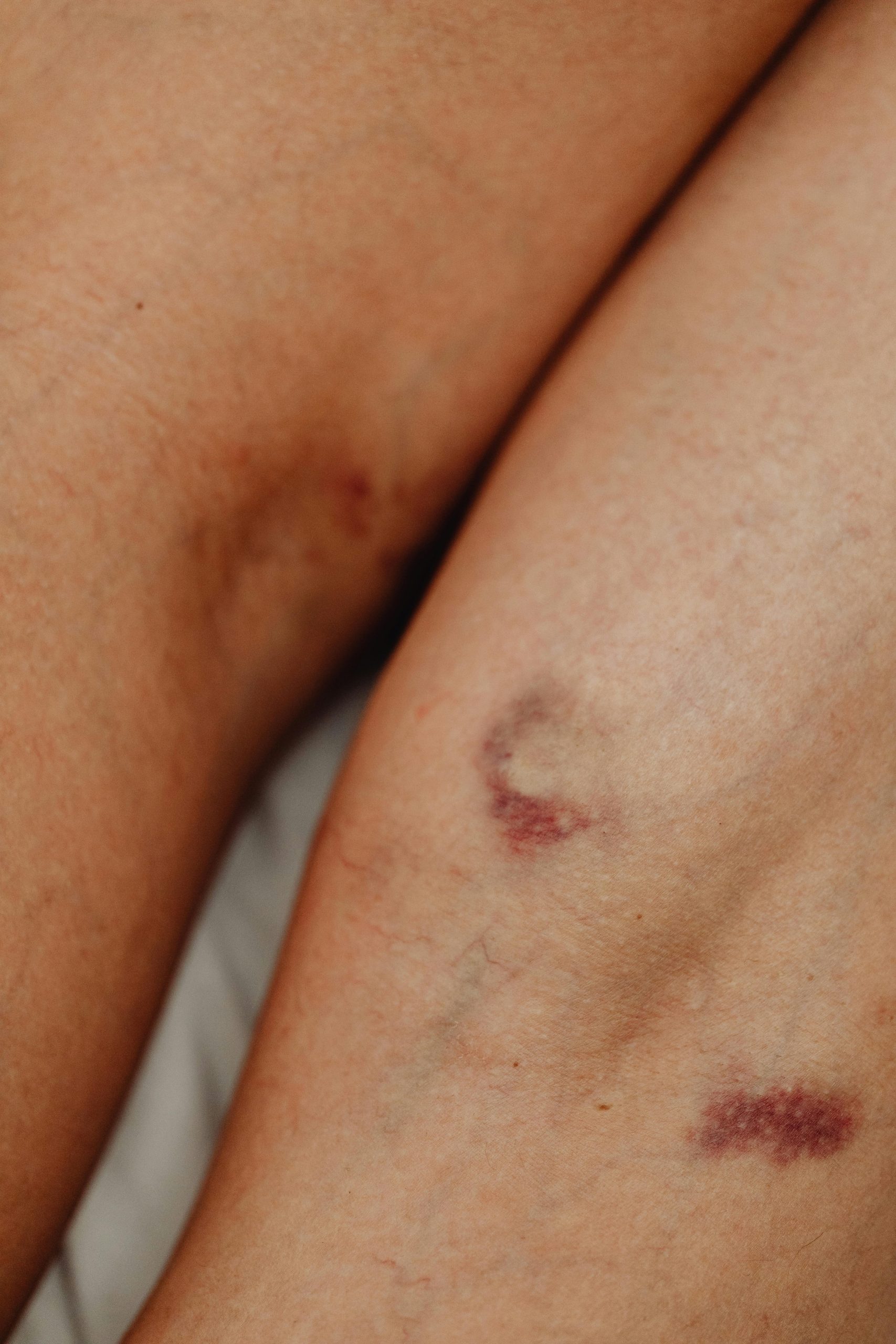 La guida definitiva per una corretta gestione delle lesioni: Wound Hygiene in cartella clinica