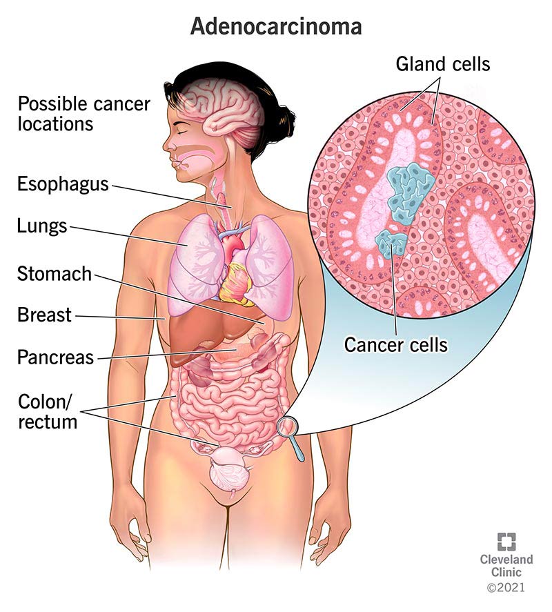 Il mistero dell'adenocarcinoma polmonare mucinoso: una guida completa alla sua identità e trattamento