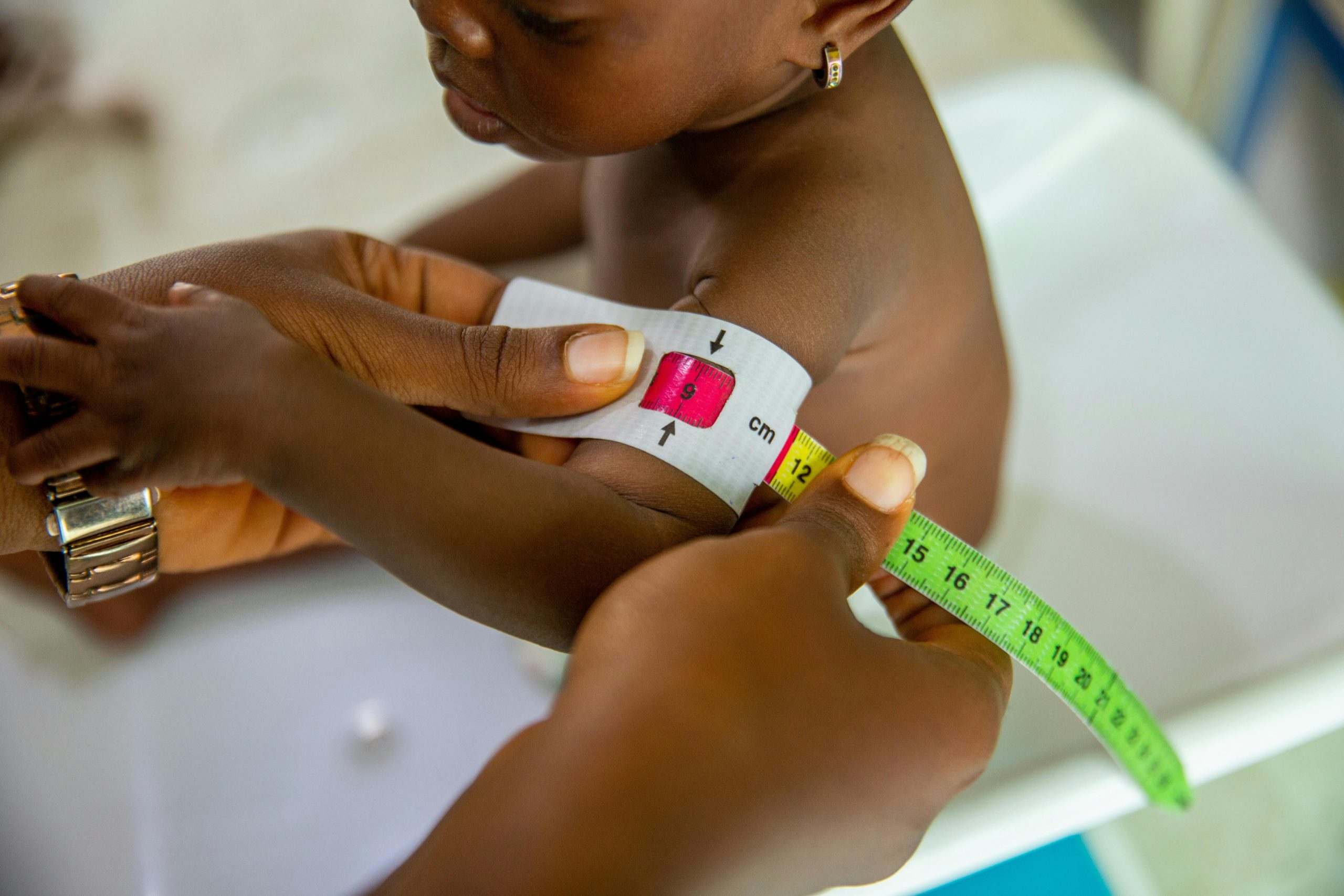 Il Morbillo fa preoccupare: la denutrizione contribuisce all'aumento dei casi