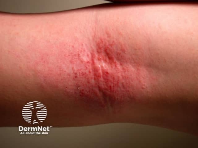Pelle sana, vita felice: tutto quello che devi sapere sulla dermatite atopica
