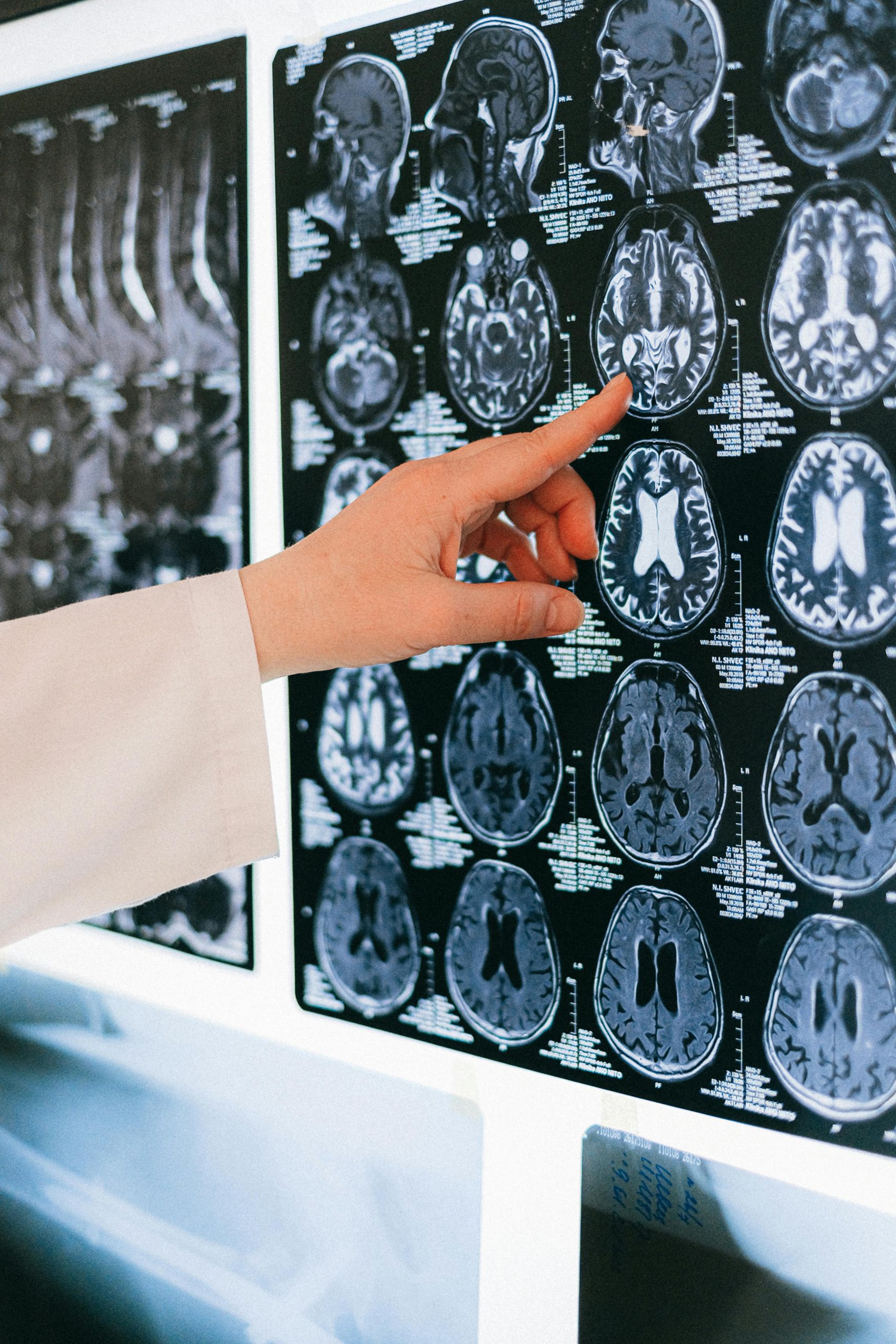 Ictus cerebrale: come la tecnologia sta rivoluzionando le diagnosi a Viterbo